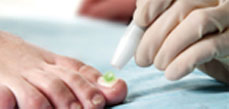 New Laser Treatment for Nail Fungus /
Onychomycosis